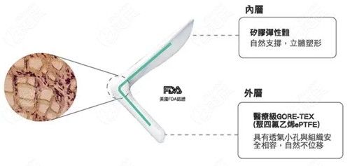 韓國(guó)隆鼻手術(shù)常用的膨體假體