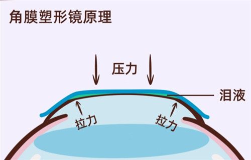 角膜塑形鏡原理過程