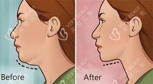 熱拉提前后對(duì)比