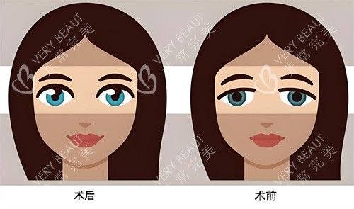 雙眼皮術(shù)后術(shù)前對比動畫圖
