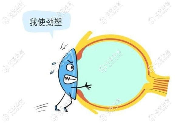 韓國(guó)露晰得角膜塑形鏡和日本阿爾法都是比較好的OK鏡