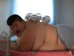 拔罐減肥有效嗎？