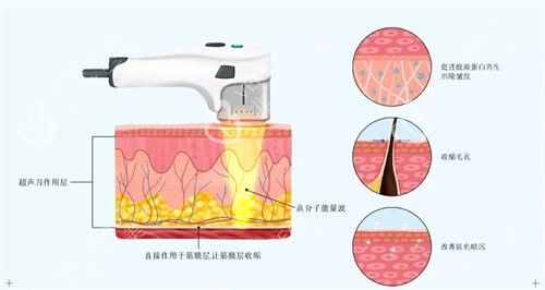 超聲炮原理