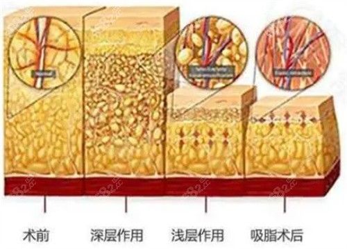 羅忠振醫(yī)生吸脂價(jià)格