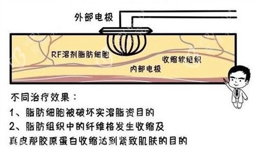 溶脂原理
