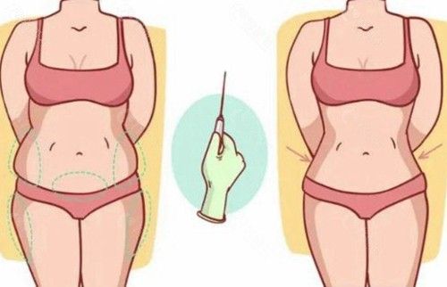 大體重吸脂前后對(duì)比照片