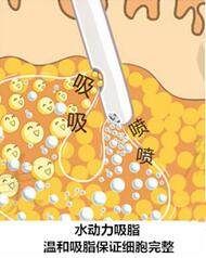 吸脂手術(shù)費(fèi)用價格一覽表