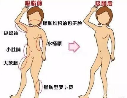 吸脂術(shù)可有效改善脂肪堆積