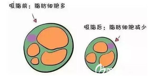 做完腹部吸脂后脂肪顆粒變少