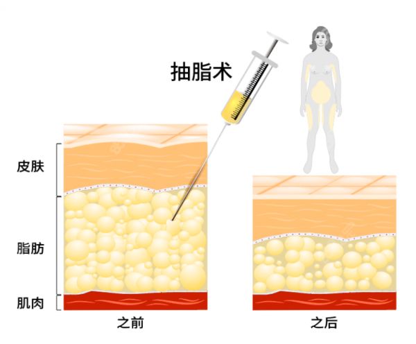吸脂減肥全部過程