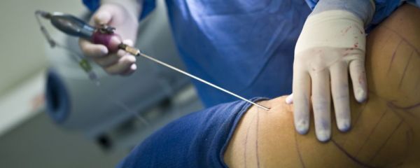 昆明吴氏嘉美 昆明吴氏嘉美吸脂