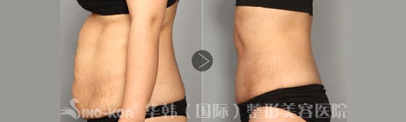腹部吸脂減肥前后對比圖
