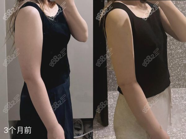 深圳陽(yáng)光整形美容醫(yī)院吸脂價(jià)格表