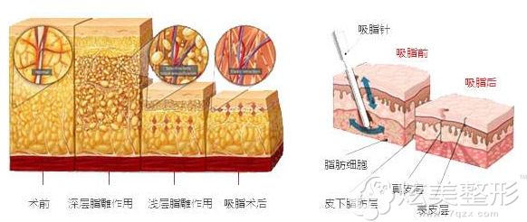 腹部吸脂减肥手术后多久能恢复,会不会反弹