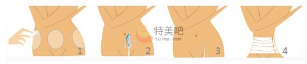 腰腹部吸脂
