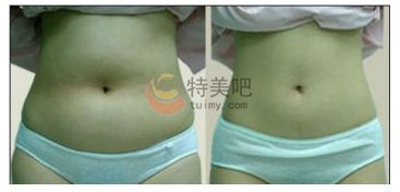 腰腹部吸脂案例