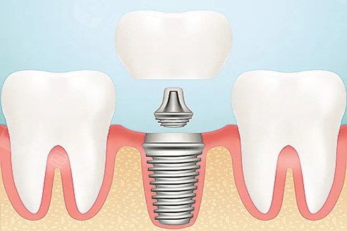 口腔種植牙卡通示意圖
