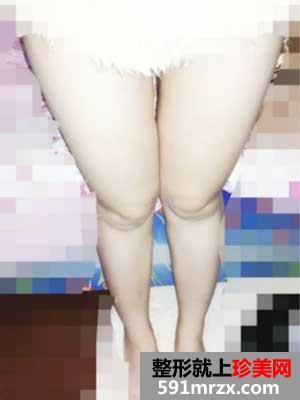 大腿+臀部吸脂手術(shù)前后效果對比圖和恢復(fù)過程
