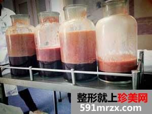 大腿+臀部吸脂手術(shù)前后效果對比圖和恢復(fù)過程