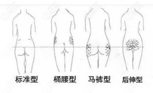 四種常見的臀部形態(tài)