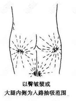 臀部抽脂部位的示意圖
