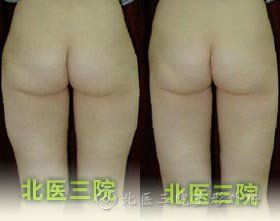臀部吸脂