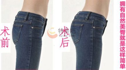 臀部吸脂案例