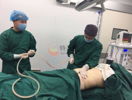 臀部吸脂