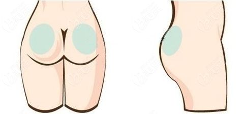 臀部吸脂手術(shù)全過程圖解www.236z.com