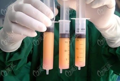 馮斌抽脂記錄：馮斌整形真人實例腰腹臀吸脂-馮斌臀部吸脂實例展示-觀看