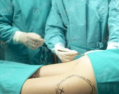 馮斌整形真人實例腰腹臀吸脂www.236z.com