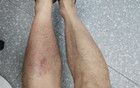 廣東一男子雨中蹚水后，高燒40℃還染上丹毒，緊急提醒→