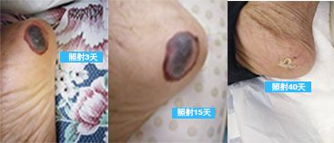 86歲褥瘡老人的奇跡康復(fù) ——全科治療儀是家庭醫(yī)生的好助手