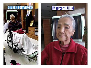 86歲褥瘡老人的奇跡康復(fù) ——全科治療儀是家庭醫(yī)生的好助手