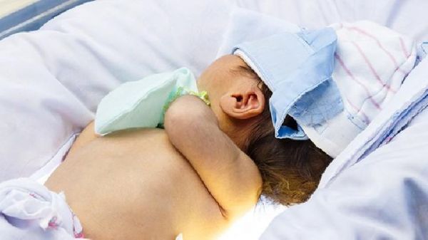 食物過敏或致嬰兒濕疹! 治療嬰兒濕疹的6步驟要謹記