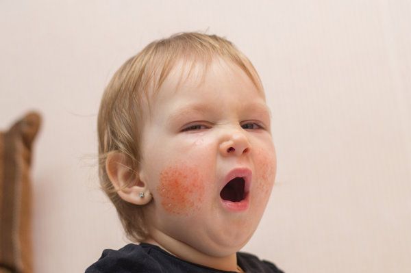 婴儿皮肤过敏有哪些食物