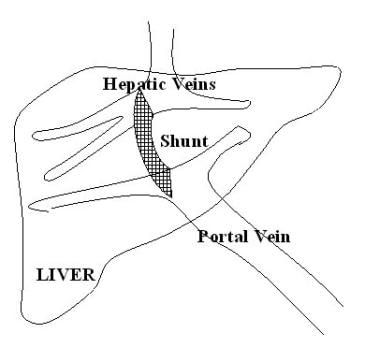 Ascites. Transjugular intrahepatic portosystemic s