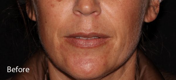 BBL Hyperpigmentation Before Treatment