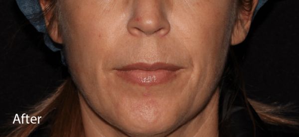 BBL Hyperpigmentation After Treatment