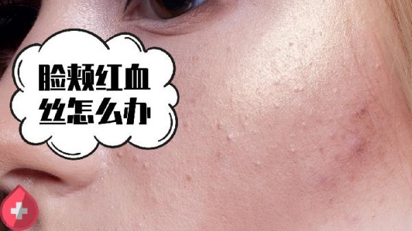 哪些方法治療青春痘最好 美容專(zhuān)家推薦激光祛痘療法