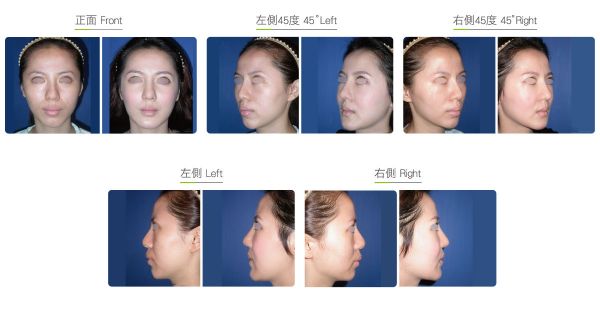 全臉整形手術(shù)（女）效果圖,案例前后對比照片