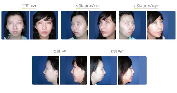 全臉整形手術(shù)（女）效果圖,案例前后對比照片