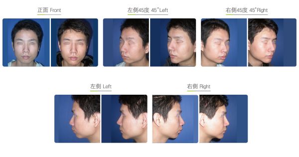 全臉整形手術(shù)（男）效果圖,案例前后對比照片