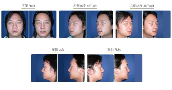 全臉整形手術(shù)（男）效果圖,案例前后對比照片