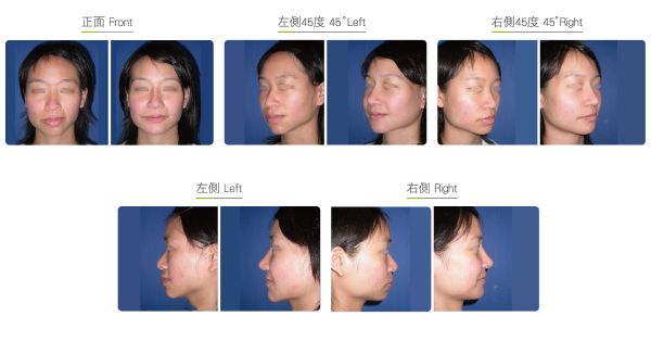 全臉整形手術(shù)-不對稱臉型矯正效果圖,案例前后對比照片