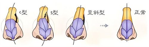 歪鼻矯正類型