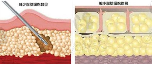 南京哪位医生做吸脂手术好一点