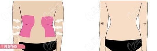 重庆王润芝医生做吸脂手术怎么样