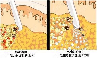 柳州抽脂多少錢一次