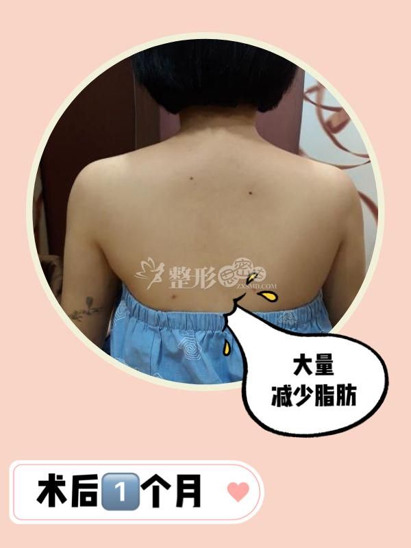 背部痤瘡如何治療_背部減肥_背部和胳膊減肥
